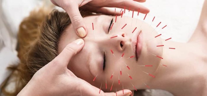Myths about Acupuncture